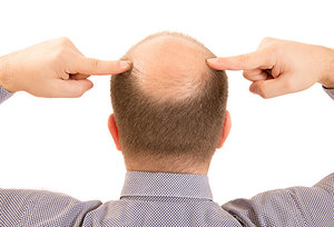 hair loss - Copyright – Stock Photo / Register Mark